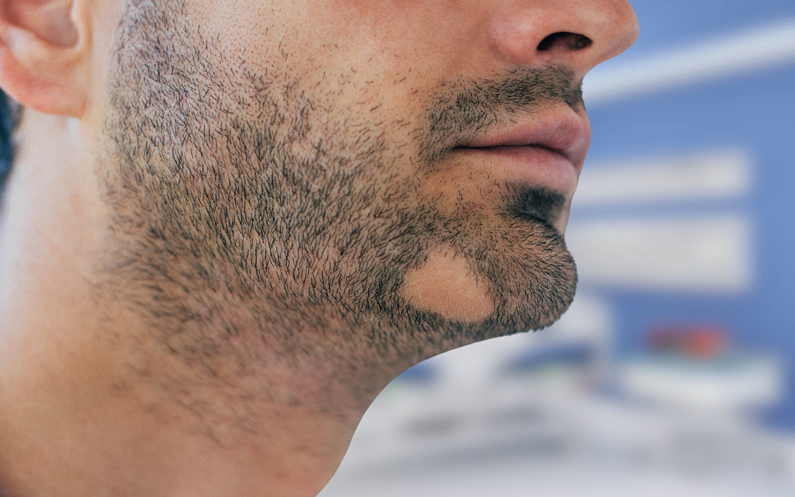 Young,Man,With,Alopecia,Areata,On,His,Beard.